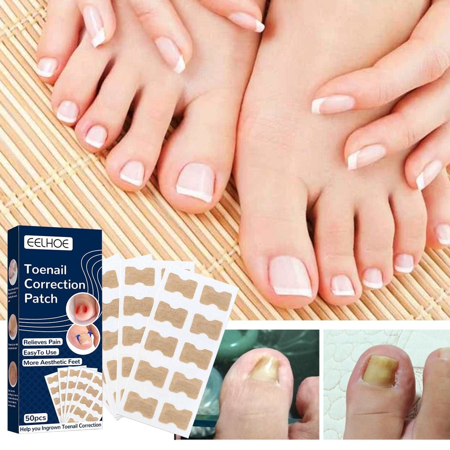 Nail Correction Patch