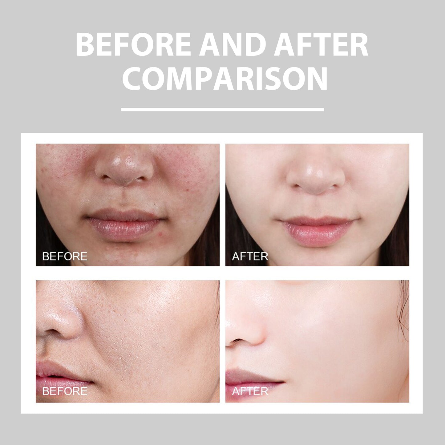 Hydrating Cream and Lightening Facial Acne Repair Redness Brightening Moisturizing Cream