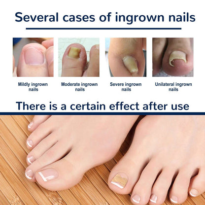 Nail Correction Patch