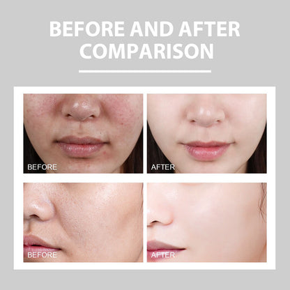 Hydrating Cream and Lightening Facial Acne Repair Redness Brightening Moisturizing Cream